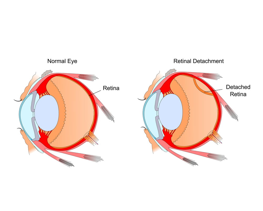 Retina Specialist in Ahmedabad, Best Retina Specialist in Ahmedabad, Retina Specialist Doctor in Ahmedabad,  Retinal Surgeons in Ahmedabad,  Retinal Hospital in Ahmedabad,  Retinal Detachment in Ahmedabad, retina specialist in gujarat, retina specialist in ellisbridge, retina specialist in rajasthan